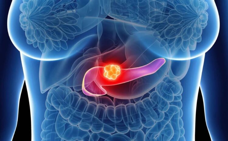 Diagnóstico rápido do câncer de pâncreas: avanço inédito no Brasil